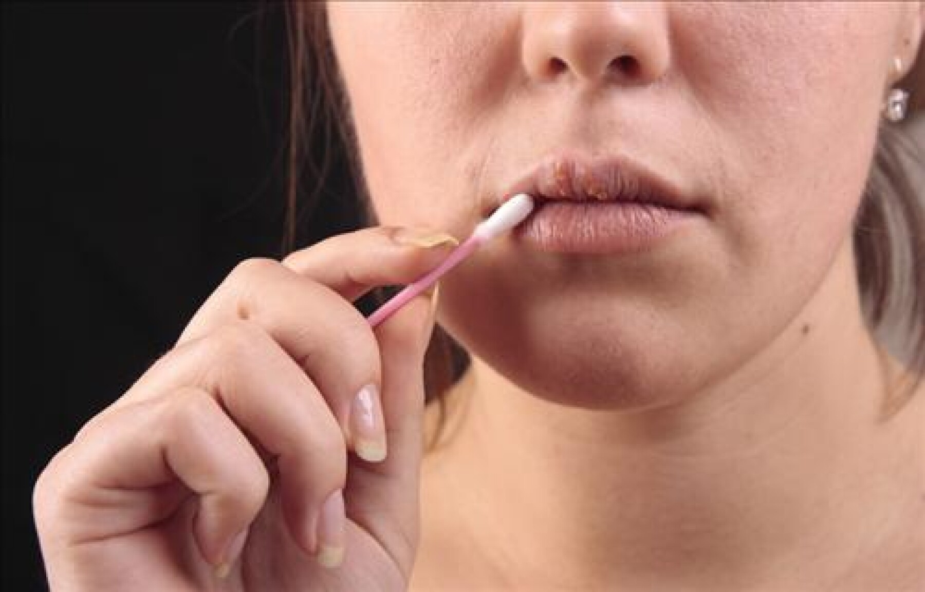 Le Point Sur L Herpes